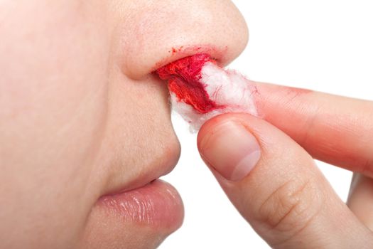 Wound nosebleed - adult human nose injury blood