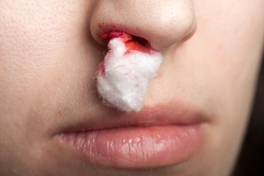 Wound nosebleed - adult human nose injury blood