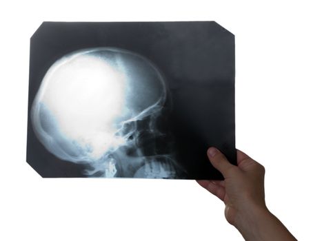 X-ray medicine film of human skull bone in hand