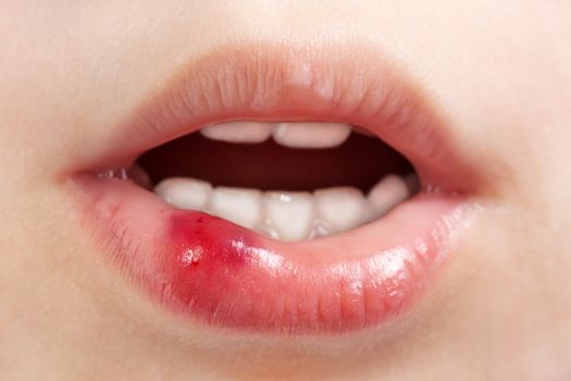 Physical injury blood wound human child mouth lip