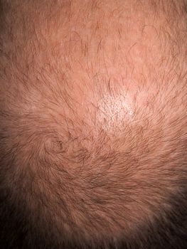 Bald hair head of adult men completely balding