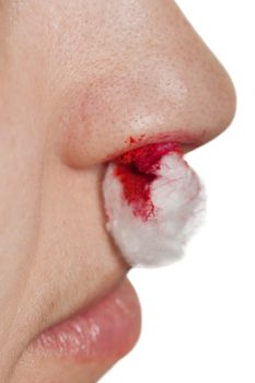 Wound nosebleed - adult human nose injury blood