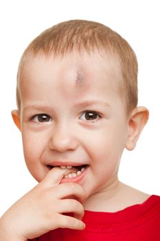 Physical injury blood bruise on wound human child