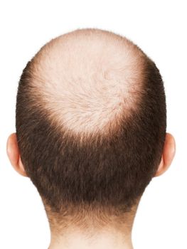 Human alopecia or hair loss - adult men bald head