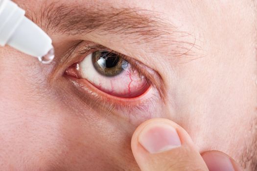 Medicine healthcare liquid eyedropper on human eye