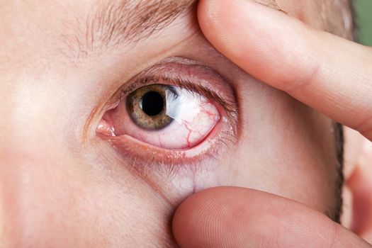 Medicine healthcare blood capillary human eye pain