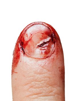 Physical injury blood wound human hand finger nail