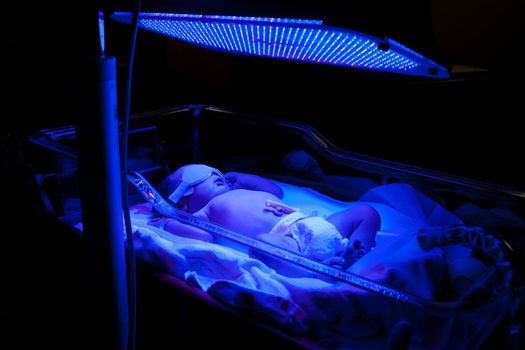 Newborn baby with neonatal jaundice and high bilirubin hyperbilirubinemia under blue UV light for phototheraphy.