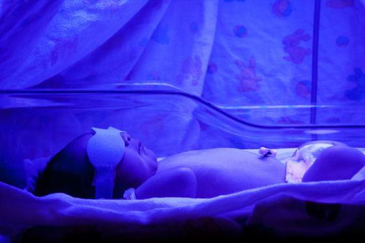Newborn baby with neonatal jaundice and high bilirubin hyperbilirubinemia under blue UV light for phototheraphy.