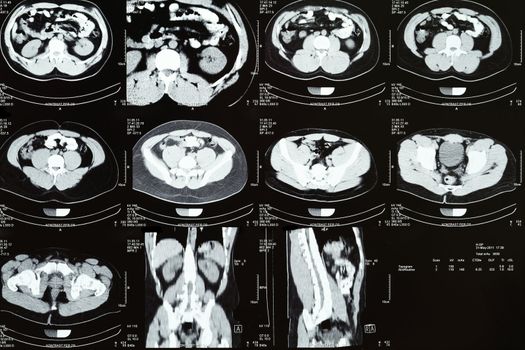 Computed tomography (CT) of the abdomen