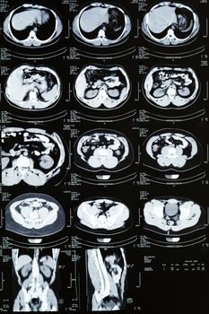 Computed tomography (CT) of the abdomen