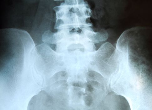 X-ray of the pelvis and spinal column. 