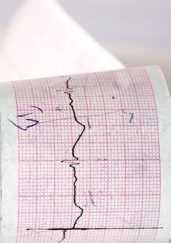 Electrocardiogram CTG macro