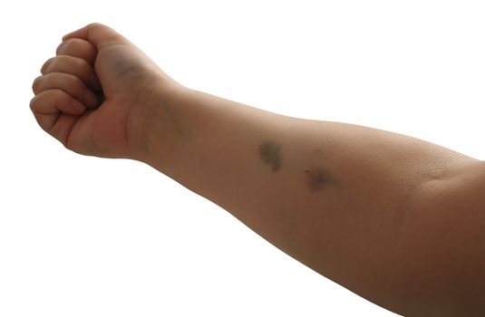 Arm with injection bruises and closed fist isolated on white background