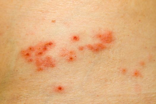 Mild case of shingles rash on the side of the body.