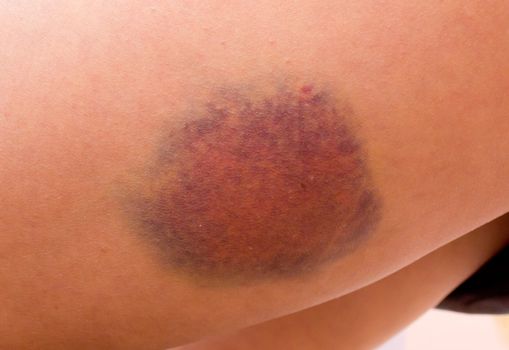 Bruise on a leg