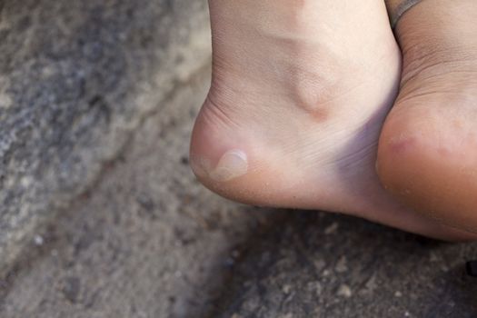 Girl with wounds in the feet