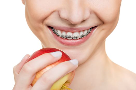 woman with brackets on teeth close up