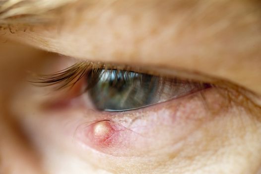 Closeup of an inflamed stye on a lower eyelid.