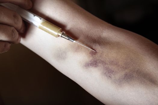 Hand with bruise and heroin syringe. Close-up photo. Natural colors