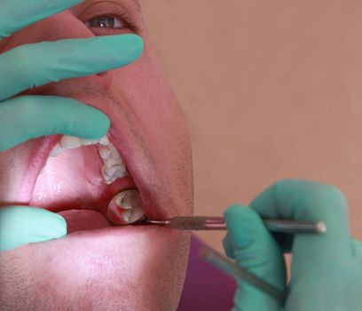Close-up image of the dentist's hands examining the teeth of a patient.