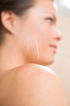 Acupuncture needle pricking on woman shoulder therapy closeup