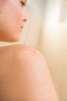 Acupuncture needle pricking on woman shoulder therapy closeup