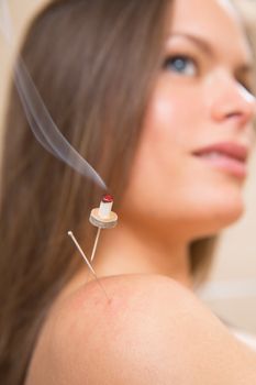 moxibustion acupunture needles heat on woman shoulder closeup