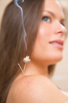 moxibustion acupunture needles heat on woman shoulder closeup