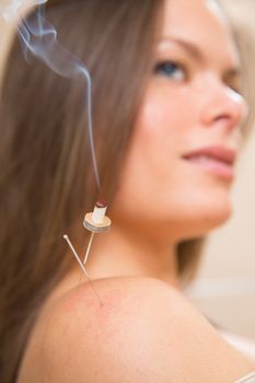 moxibustion acupunture needles heat on woman shoulder closeup