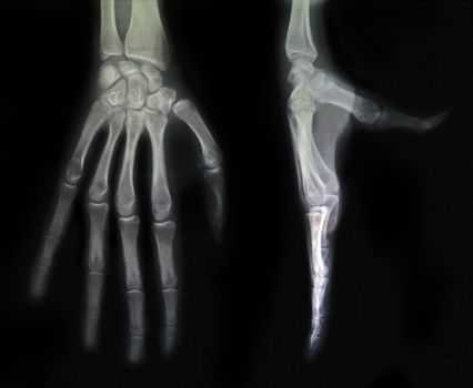 Two views of a hand in an x-ray.