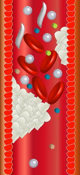 A graphic profile of a bloodstream showing the symptom of a heart attack.