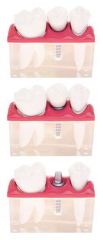 dental model with different types of treatments (implant placement, bonded bridge, crown over implant) isolated on white background