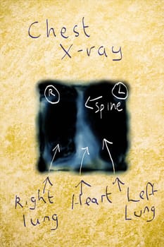Annotated picture of a chest x-ray on a grungy piece of parchment