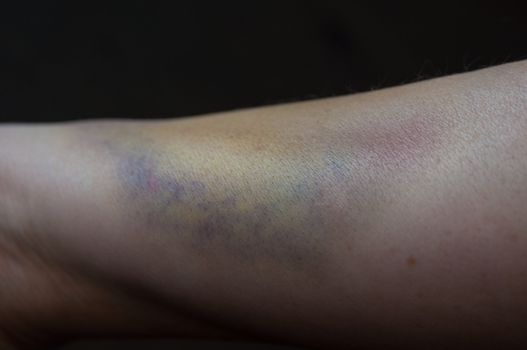 Close-up of a bruised arm of a woman on dark background