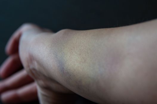 Close-up of a bruised arm of a woman on dark background