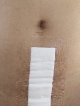 Adhesive bandage care of patients wound after abdominal operate