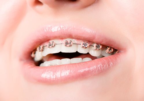 Beautiful young woman with brackets on teeth close up