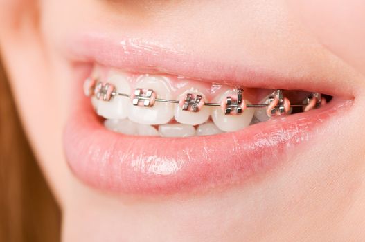 Beautiful young woman with brackets on teeth close up