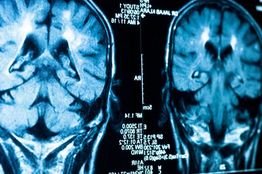 Closeup of a CT scan with brain