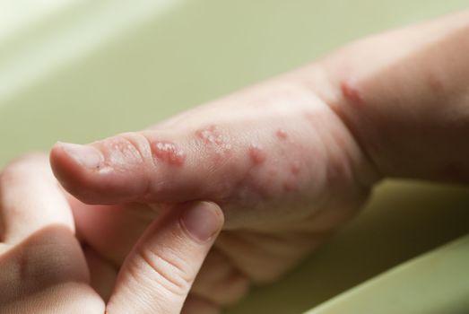 Blisters caused by herpes zoster in the hand and arm of a child.