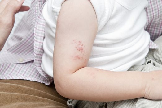 Blisters caused by herpes zoster in the hand and arm of a child.