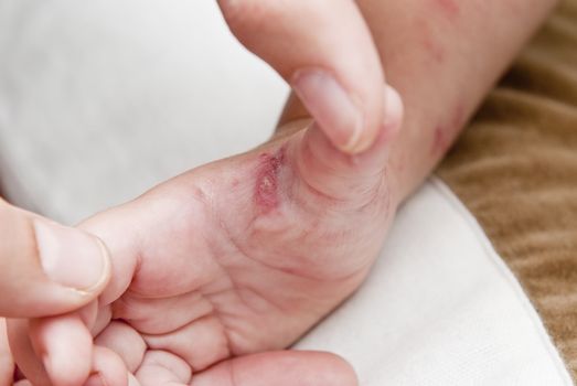 Blisters caused by herpes zoster in the hand and arm of a child.