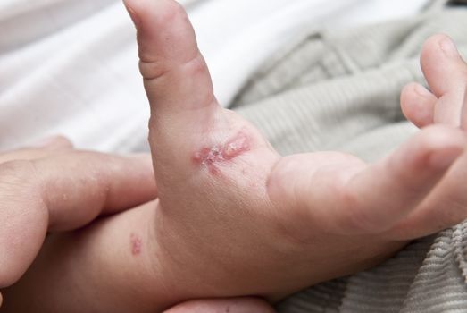 Blisters caused by herpes zoster in the hand and arm of a child.