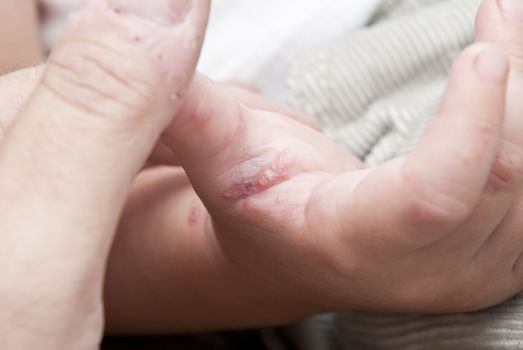 Blisters caused by herpes zoster in the hand and arm of a child.