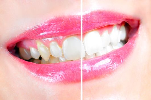 Before and after of a dental whitening procedure