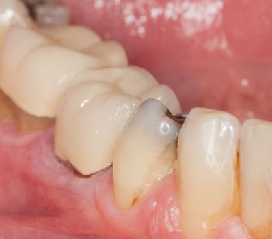 Close up macro shot of interior of mouth and fillings and crowns on teeth