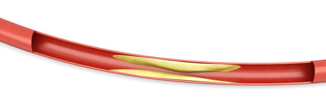 Arteriosclerosis. Plaques tightening an artery. 3D rendered Illsutration. Isolated on white.