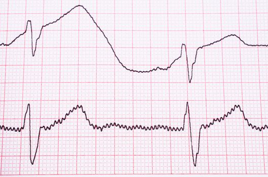 EKG diagramm on paper