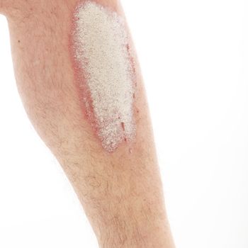 Psoriasis on lower legs - close up up on white background
